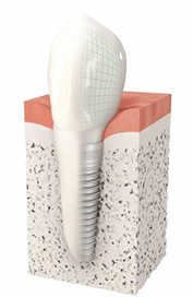 implant dentaire strasbourg Dentiste Michel Boeshclin
