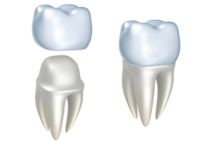 couronne dentaire en céramique dentiste Strasbourg