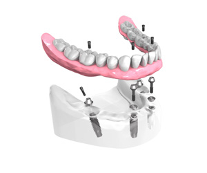 implant dentaire Denstite Strasbourg Dr Michel Boeschlin