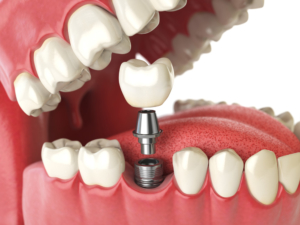 implant dentaire strasbourg Dentiste Michel Boeschlin