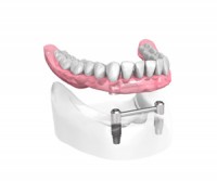 implant dentaire Denstite Strasbourg Dr Michel Boeschlin
