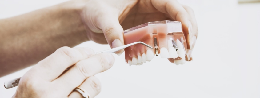 question fréquente implant dentaire Dentiste Michel Boeschlin à Strasbourg